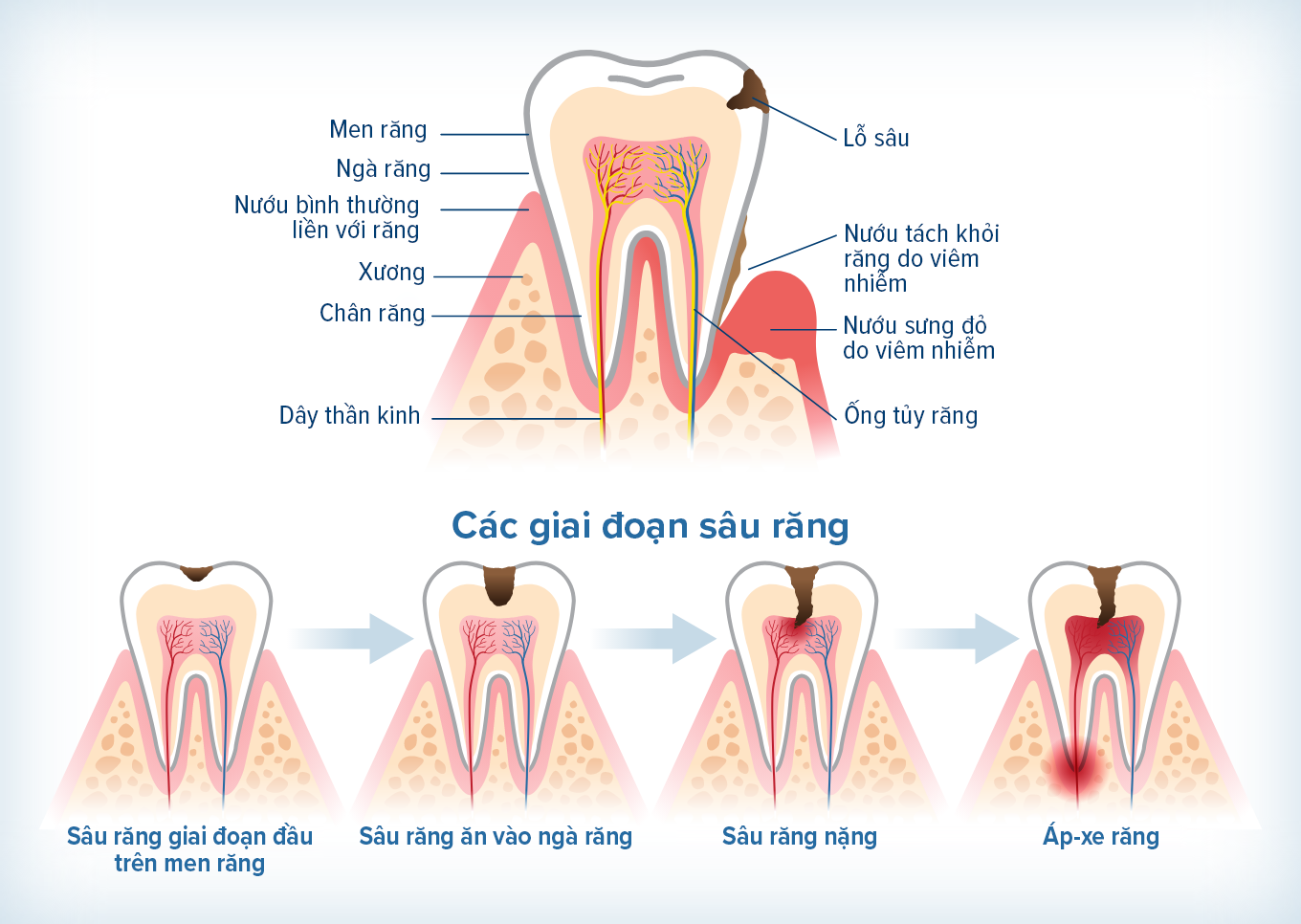 Hình minh họa dưới đây cho thấy tiến trình sâu răng, từ sâu răng giai đoạn đầu trên men răng cho tới áp-xe răng.